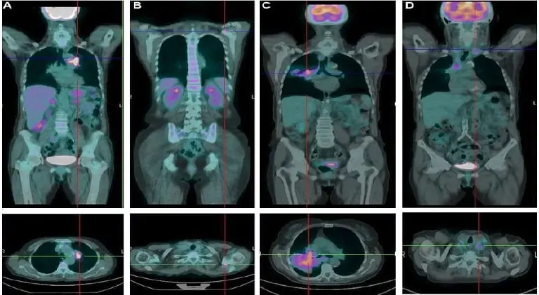 PET CT Scan for Cancer Treatment