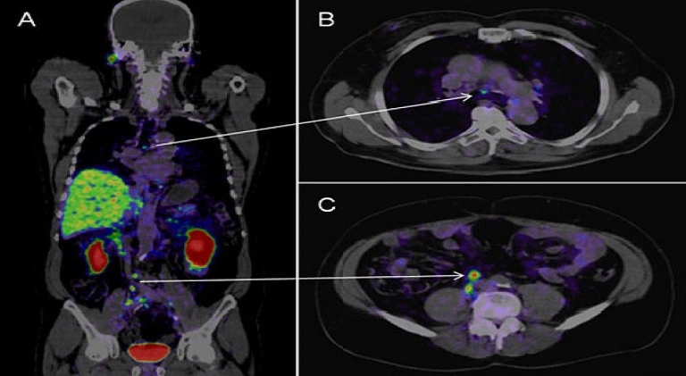 PET CT Scan for Cancer